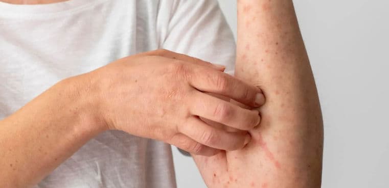 Estados en México con más casos de sarampión hasta hoy